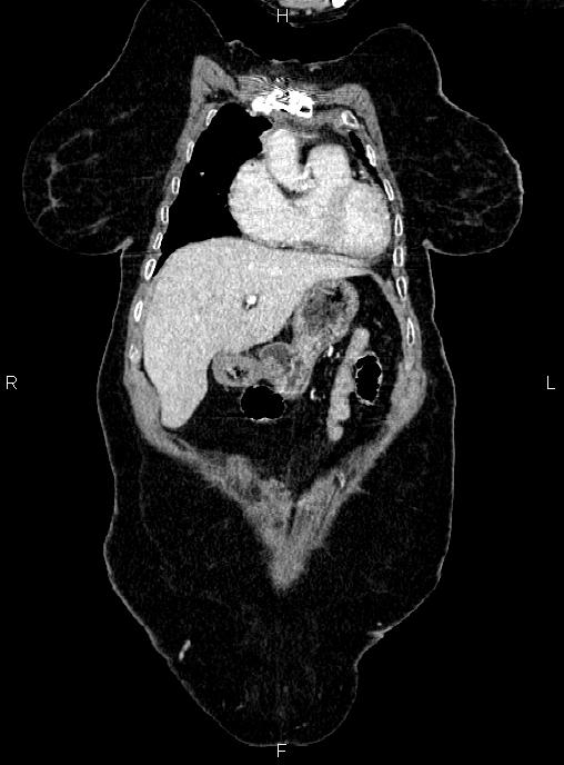 Abdominal aortic aneurysm (Radiopaedia 85063-100606 Coronal C+ arterial phase 7).jpg