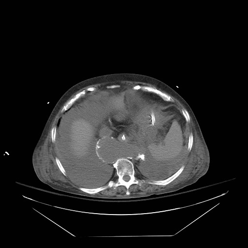 Abdominal aortic aneurysm - impending rupture (Radiopaedia 19233-19247 Axial non-contrast 32).jpg