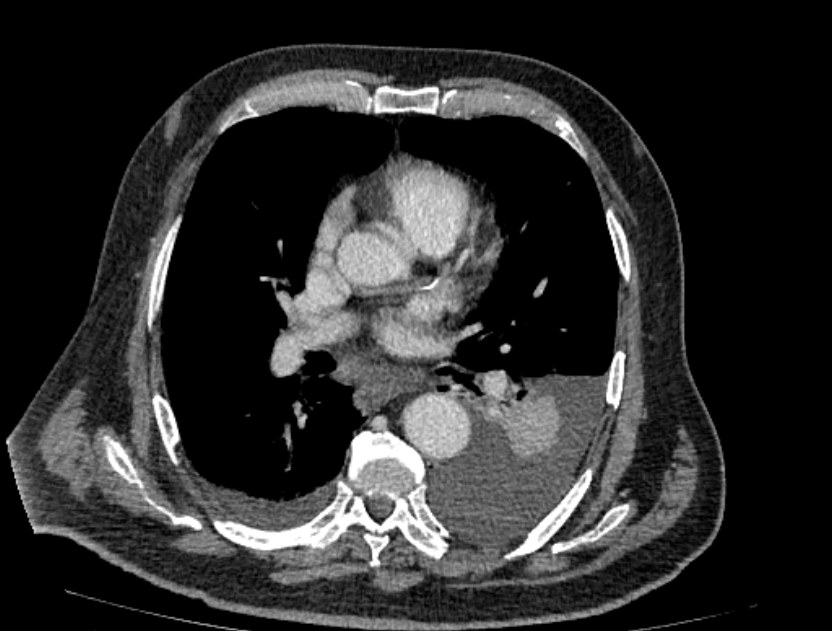 Abdominal aortic aneurysm rupture (Radiopaedia 54179-60362 Axial C+ portal venous phase 42).jpg