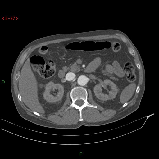 Abdominal aortic aneurysm rupture with aortocaval fistula (Radiopaedia 14897-14841 Axial C+ arterial phase 97).jpg