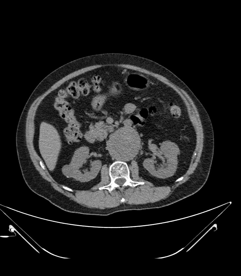 Abdominal aortic aneurysm with thrombus fissuration (Radiopaedia 46218-50618 Axial non-contrast 20).jpg