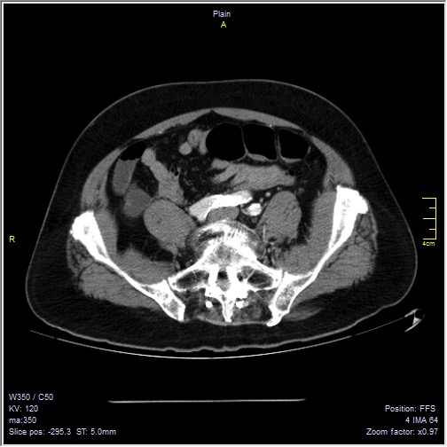 Abdominal aortic aneurysm with thrombus fissuration (Radiopaedia 47340-51926 Axial C+ arterial phase 48).jpg