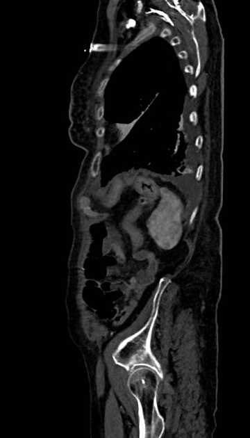 Abdominal aortic aneurysm with thrombus fissuration (Radiopaedia 73192-83919 Sagittal C+ arterial phase 16).jpg