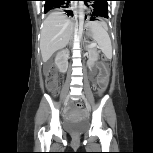 File:Abdominal gossypiboma- surgical towel (Radiopaedia 57288-64226 Coronal C+ portal venous phase 13).jpg