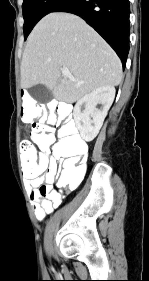 Abdominal wall and retroperitoneal tuberculosis (Radiopaedia 88137-104729 Sagittal C+ portal venous phase 109).jpg