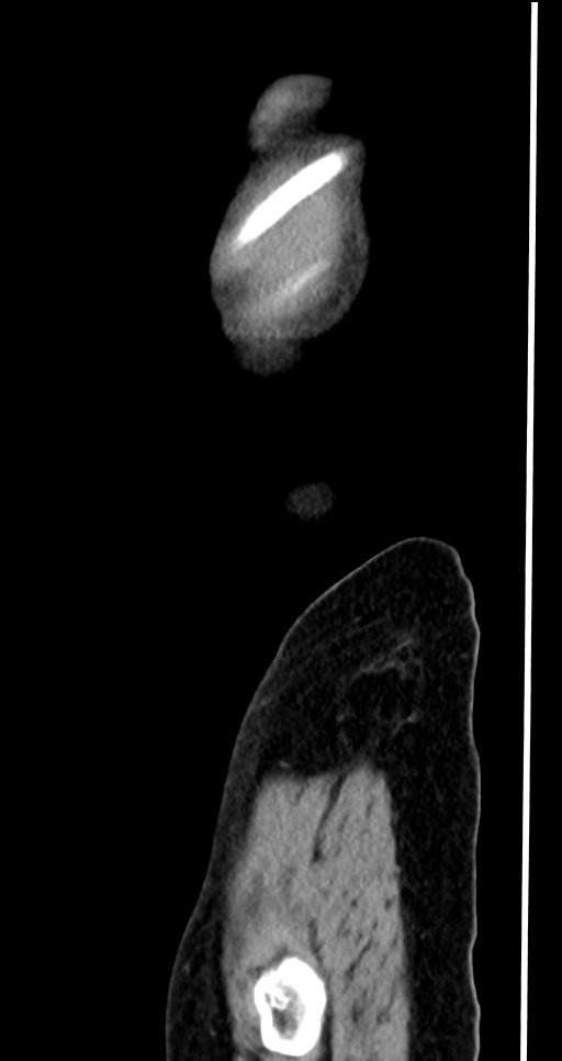 Abdominal wall and retroperitoneal tuberculosis (Radiopaedia 88137-104729 Sagittal C+ portal venous phase 11).jpg