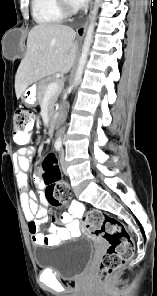 Abdominal wall and retroperitoneal tuberculosis (Radiopaedia 88137-104729 Sagittal C+ portal venous phase 74).jpg