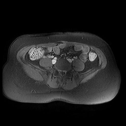 File:Abdominal wall endometriosis (Radiopaedia 83702-98847 Axial T1 C+ fat sat 16).jpg
