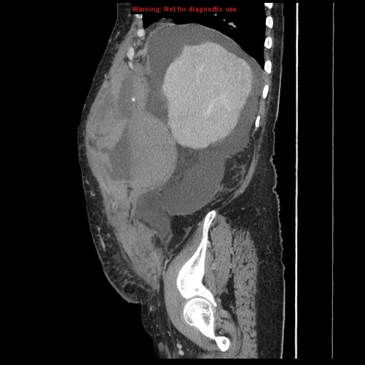 Abdominal wall hematoma (Radiopaedia 9427-10112 Sagittal C+ portal venous phase 84).jpg