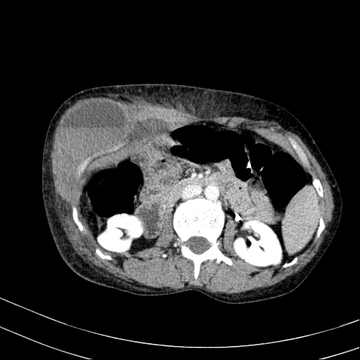 Abdominal wall hematoma with active bleeding (Radiopaedia 83915-99117 Axial C+ portal venous phase 29).jpg