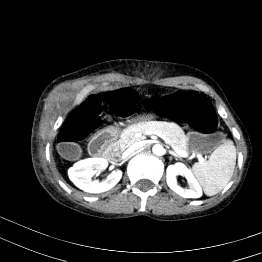 Abdominal wall hematoma with active bleeding (Radiopaedia 83915-99117 Axial renal cortical phase 14).jpg