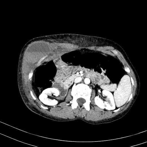 Abdominal wall hematoma with active bleeding (Radiopaedia 83915-99117 Axial renal cortical phase 24).jpg