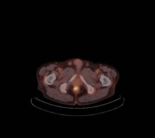 File:Abdominal wall metastasis from colorectal carcinoma (Radiopaedia 31016-31719 C 17).jpg