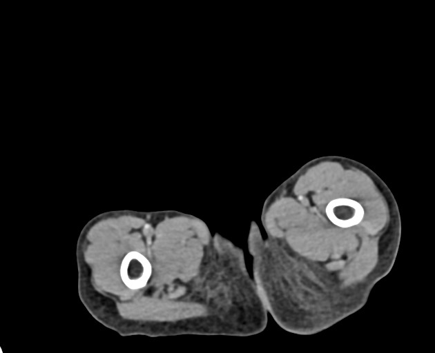 Abdominopelvic rhabdomyosarcoma (Radiopaedia 78356-90984 Axial C+ portal venous phase 170).jpg