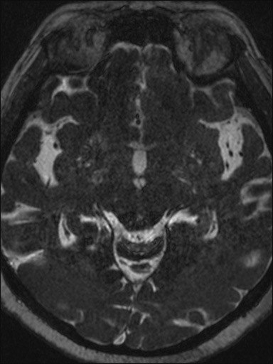 Abducens nerve palsy (Radiopaedia 57084-63976 Axial T2 ciss 3d 63).jpg