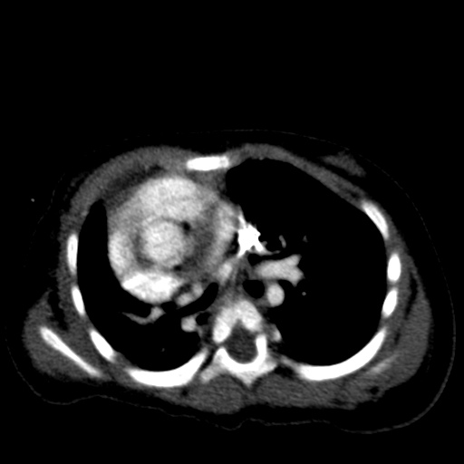 File:Aberrant left pulmonary artery (pulmonary sling) (Radiopaedia 42323-45435 Axial C+ CTPA 22).jpg