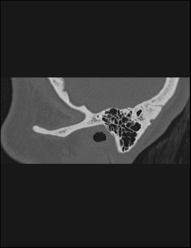 Aberrant right internal carotid artery (Radiopaedia 65191-74198 Sagittal non-contrast 17).jpg