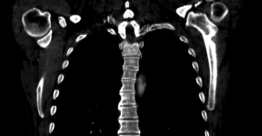 File:Accesory rib joint (Radiopaedia 71987-82452 Coronal bone window 32).jpg