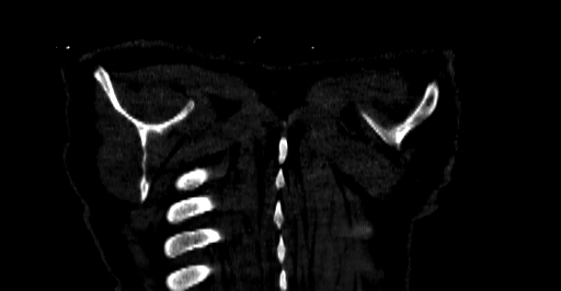 Accesory rib joint (Radiopaedia 71987-82452 Coronal bone window 93).jpg
