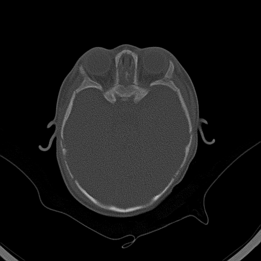 File:Accessory intraparietal suture (Radiopaedia 50584-56020 Axial bone window 12).jpg
