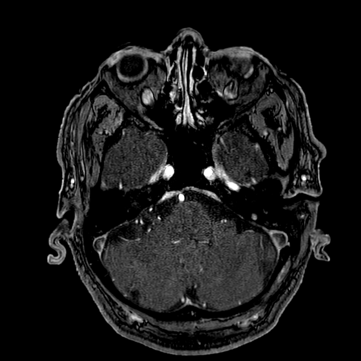 Accessory middle cerebral artery (Radiopaedia 73114-83828 Axial MRA 33).jpg