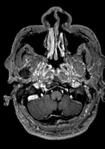Accessory middle cerebral artery (Radiopaedia 73114-83828 Axial T1 C+ 172).jpg