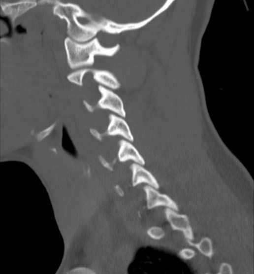 File:Accessory ossicle of the anterior arch of C1 vertebra (Radiopaedia 58149-65211 Sagittal bone window 3).jpg