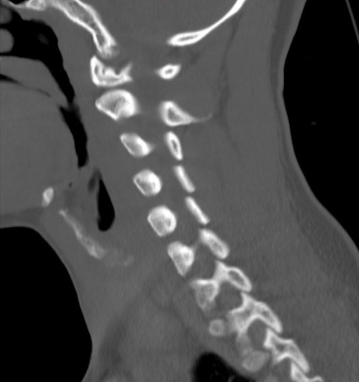 File:Accessory ossicle of the anterior arch of C1 vertebra (Radiopaedia 58149-65211 Sagittal bone window 5).jpg