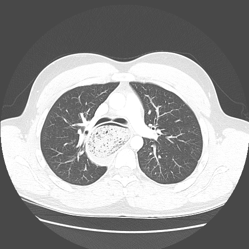 Achalasia (Radiopaedia 52507-58417 Axial lung window 24).jpg