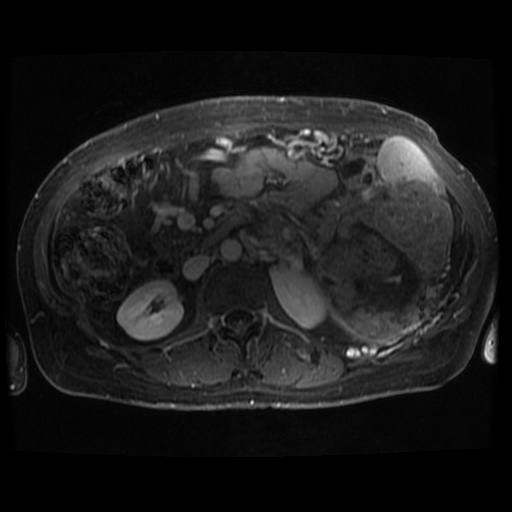 Acinar cell carcinoma of the pancreas (Radiopaedia 75442-86668 Axial T1 C+ fat sat 38).jpg