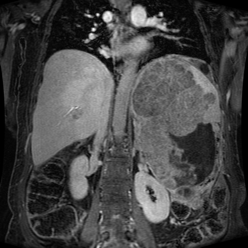 Acinar cell carcinoma of the pancreas (Radiopaedia 75442-86668 Coronal T1 C+ fat sat 82).jpg