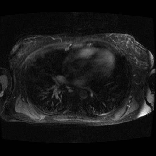 Acinar cell carcinoma of the pancreas (Radiopaedia 75442-86668 D 154).jpg