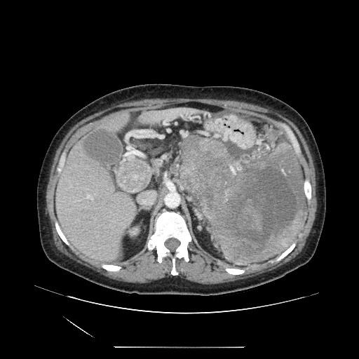 Acinar cell carcinoma of the pancreas (Radiopaedia 75442-86669 Axial C+ portal venous phase 42).jpg