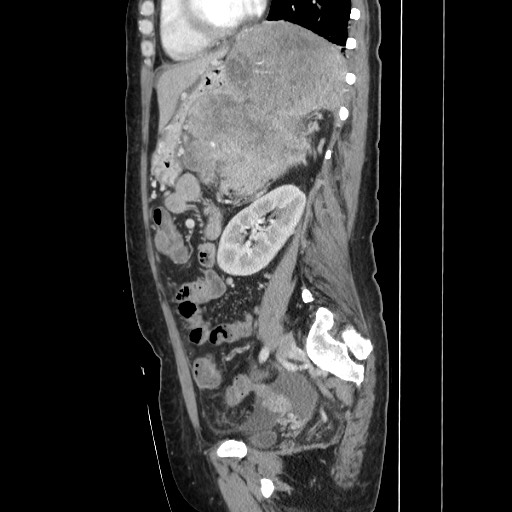 File:Acinar cell carcinoma of the pancreas (Radiopaedia 75442-86669 Sagittal C+ portal venous phase 121).jpg