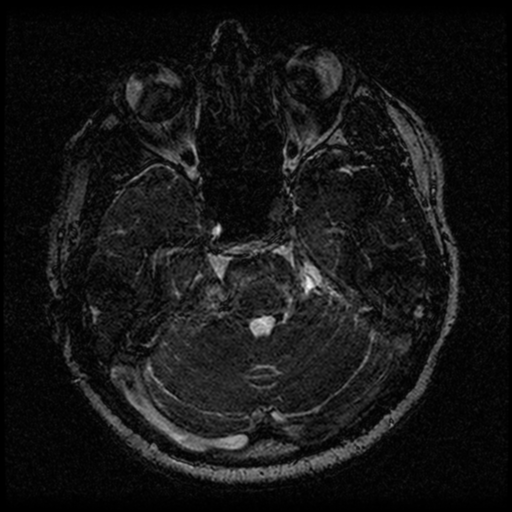 Acoustic schwannoma (Radiopaedia 33045-34060 Axial T2 50).png
