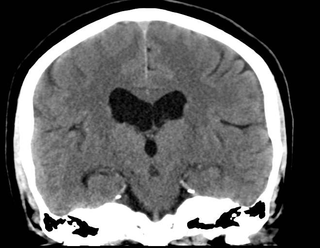 File:Acoustic schwannoma (Radiopaedia 33045-34065 Coronal non-contrast 25).png