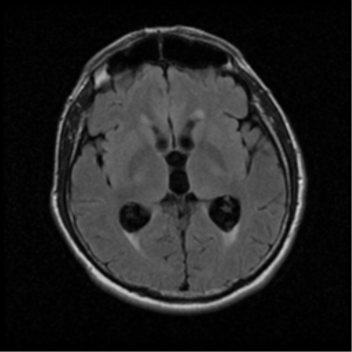 File:Acoustic schwannoma (Radiopaedia 39170-41387 Axial FLAIR 11).png