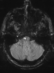 Acoustic schwannoma (Radiopaedia 55729-62281 Axial SWI 9).png