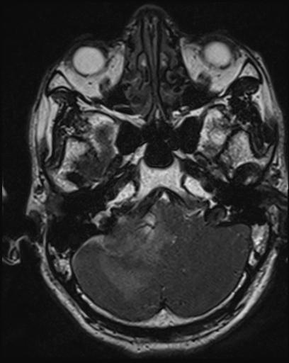 Acoustic schwannoma - probable (Radiopaedia 20386-20292 Axial T1 31).jpg