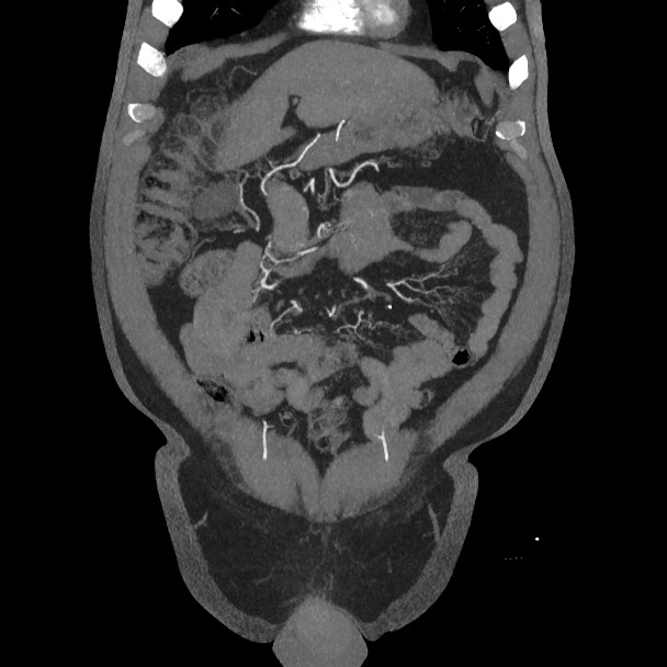 Active colonic bleed on CT (Radiopaedia 49765-55025 Coronal art MIP 19).jpg