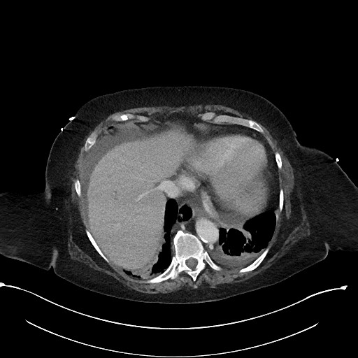 File:Active renal extravasation with large subcapsular and retroperitoneal hemorrhage (Radiopaedia 60975-68796 Axial 335).jpg
