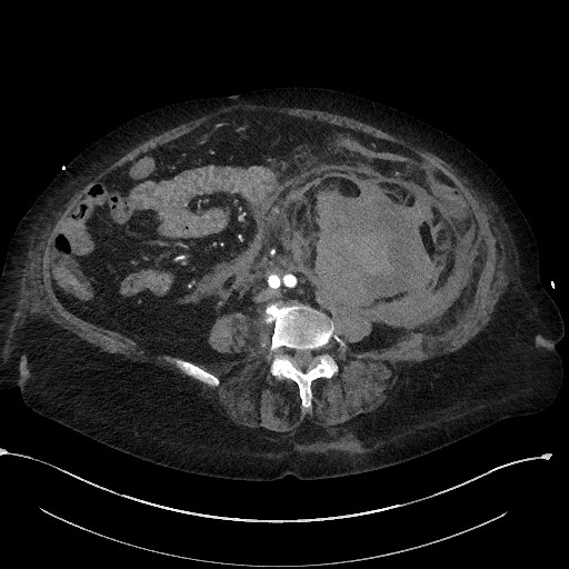 File:Active renal extravasation with large subcapsular and retroperitoneal hemorrhage (Radiopaedia 60975-68796 Axial C+ arterial phase 113).jpg