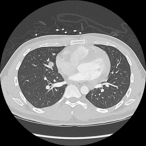 File:Active right ventricular cardiac sarcoidosis (Radiopaedia 55596-62101 Axial lung window 28).jpg