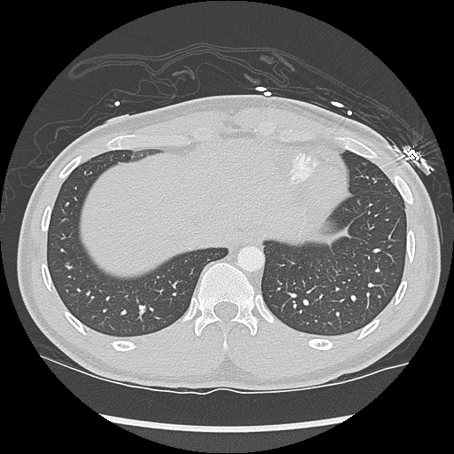 File:Active right ventricular cardiac sarcoidosis (Radiopaedia 55596-62101 Axial lung window 42).jpg