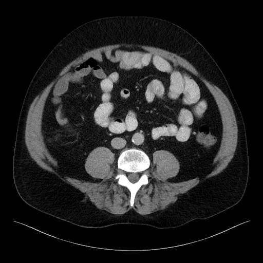 Acute-on-chronic pancreatitis (Radiopaedia 67286-76656 Axial C+ portal venous phase 48).jpg