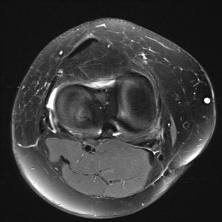 File:Acute-on-chronic transient lateral patellar dislocation with trochlear dysplasia (Radiopaedia 84099-99349 Axial PD fat sat 23).jpg