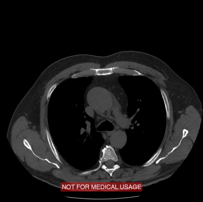 Acute aortic dissection - Stanford type A (Radiopaedia 40661-43285 Axial non-contrast 14).jpg