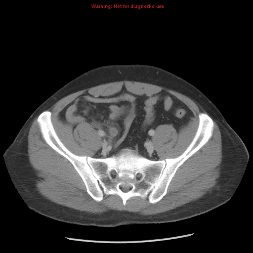 Acute appendicitis (Radiopaedia 10498-10973 Axial C+ portal venous phase 34).jpg