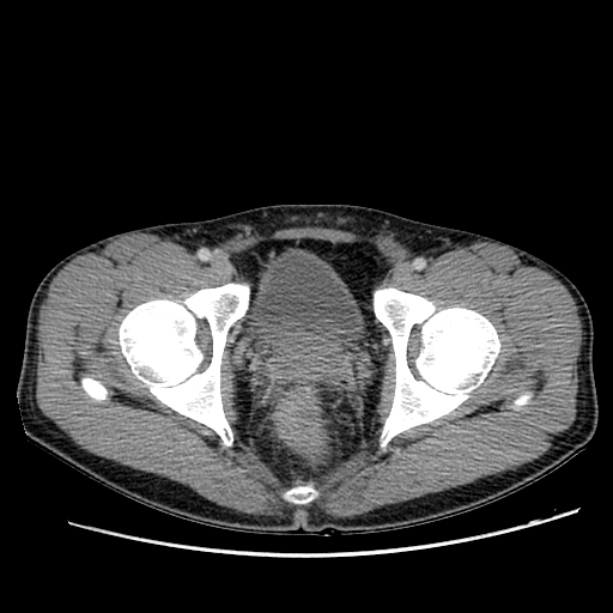 Acute appendicitis (Radiopaedia 27049-27227 Axial C+ portal venous phase 73).jpg