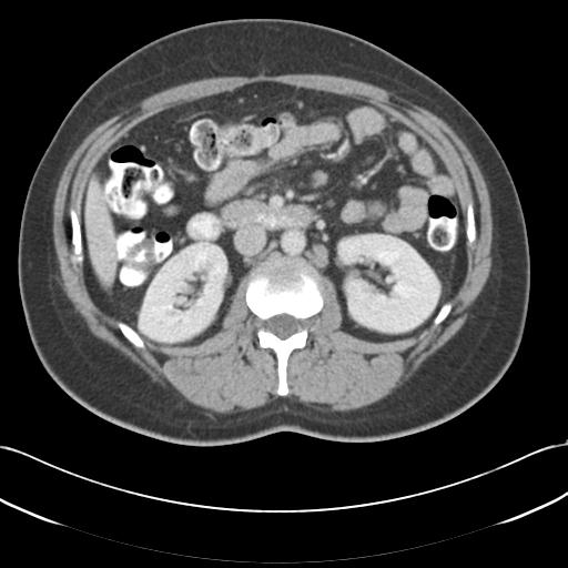 Acute appendicitis (Radiopaedia 30297-30934 Axial C+ portal venous phase 34).jpg
